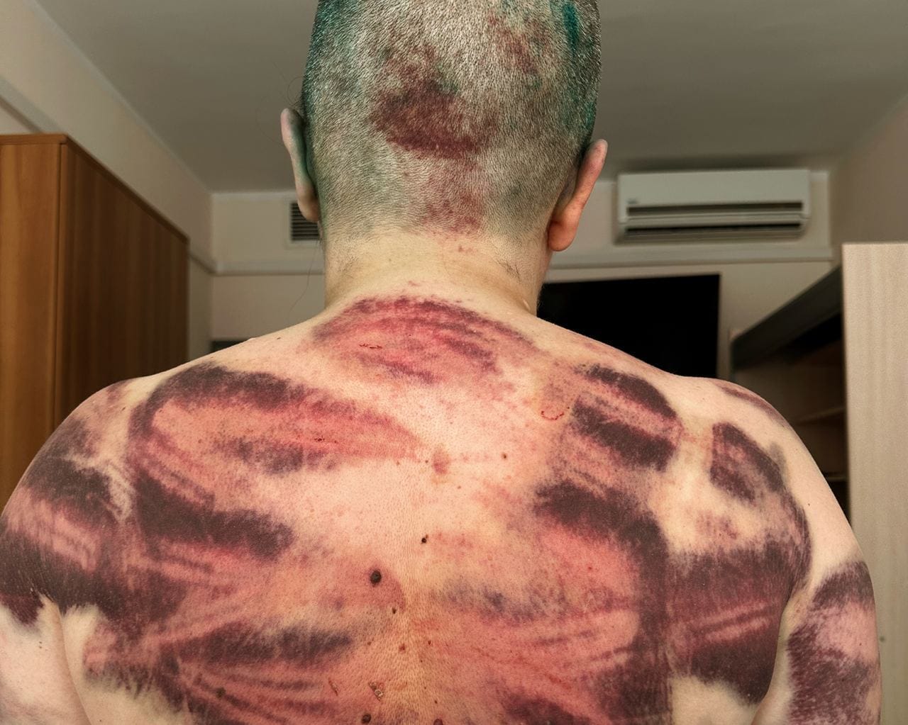 Множественные переломы, ушибы и черепно-мозговая травма. Стали известны результаты обследования журналистки Елены Милашиной, избитой в Чечне